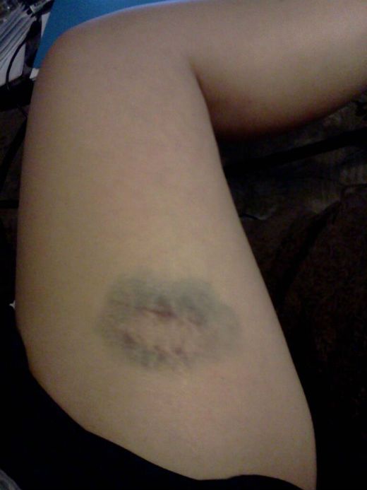 Bruise.jpg