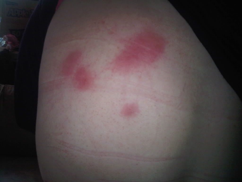 Thought it was bed bug bites on my back/thighs/arms...?? | HC Support ...