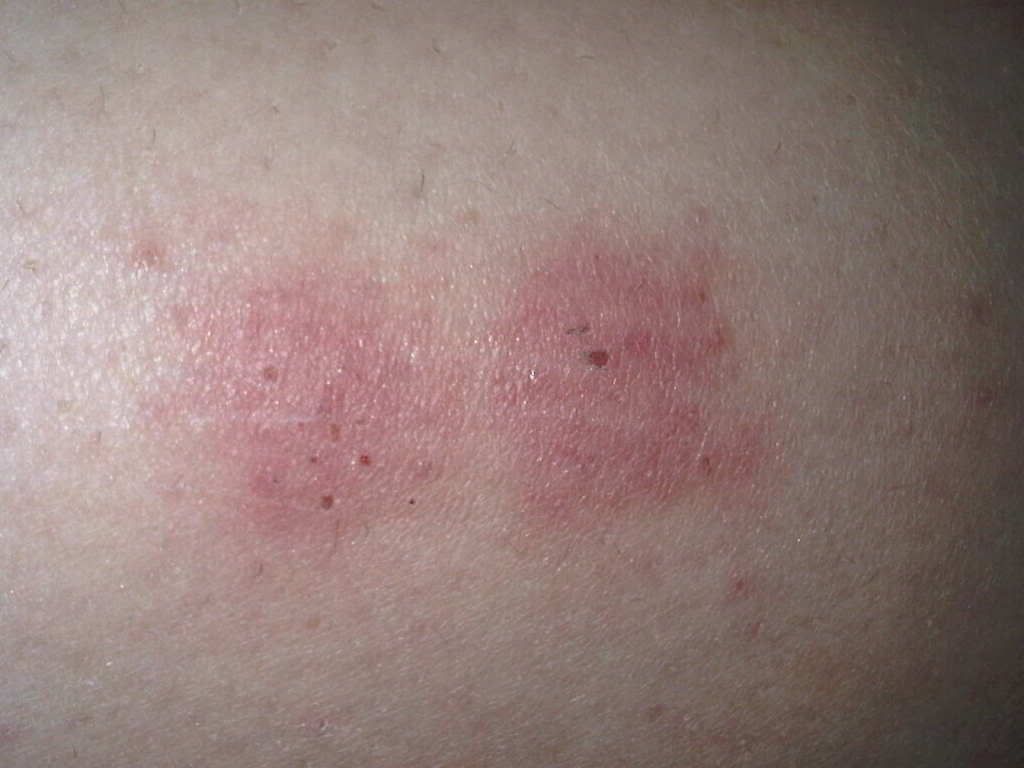 Thought it was bed bug bites on my back/thighs/arms...?? | HC Support ...